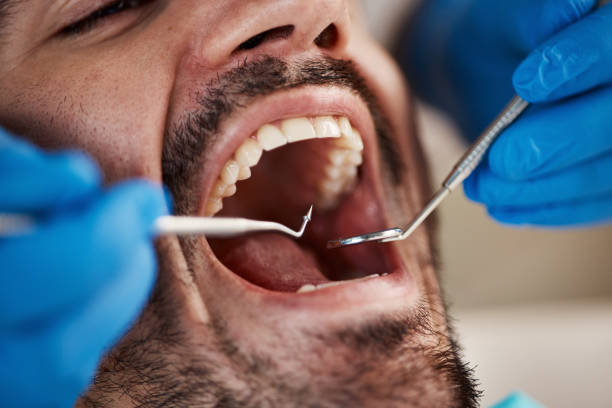 Best Knocked-Out Tooth (Avulsed Tooth) Treatment in Binghamton University, NY